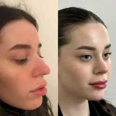 Rhinoplasty