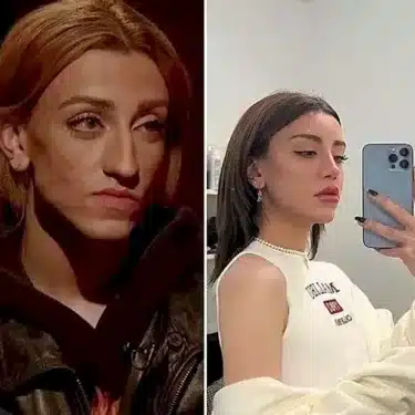 Rhinoplasty