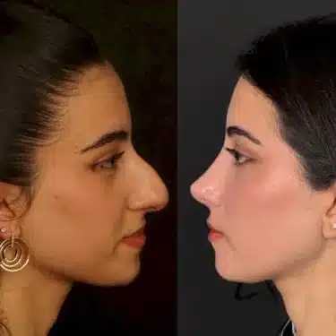 Rhinoplasty