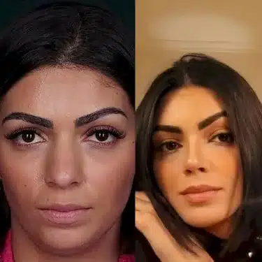 Rhinoplasty