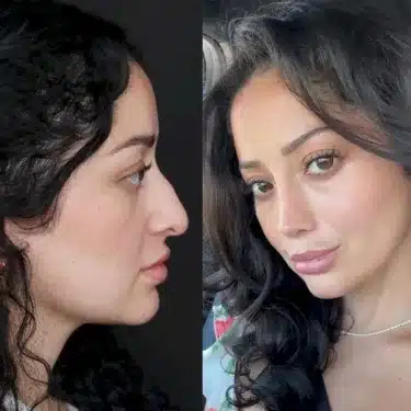 Rhinoplasty
