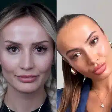 Rhinoplasty