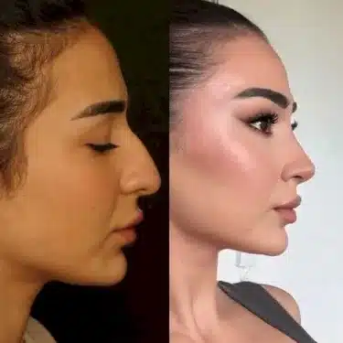 Rhinoplasty