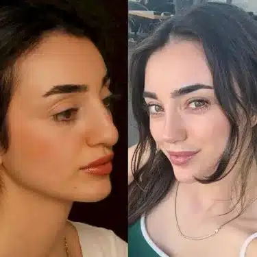 Rhinoplasty