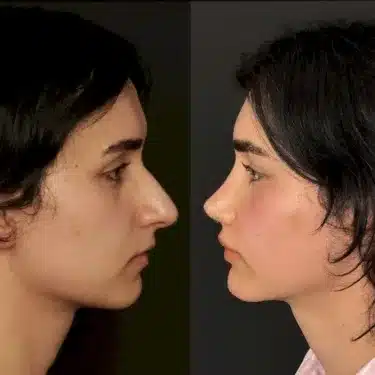 Rhinoplasty